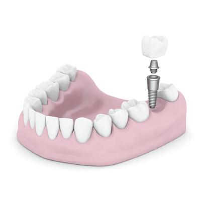 Dental implant being placed on a model tooth, scottsdale az