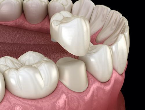 A crown being put on a tooth, scottsdale az