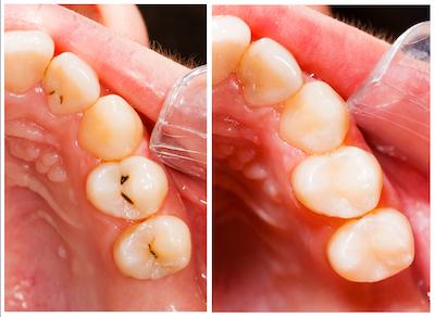Before and after composite bonding, scottsdale az