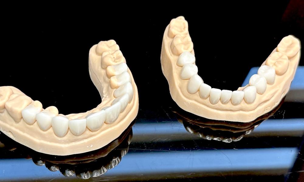 Mold of teeth for full smile makeover, scottsdale az