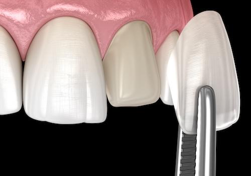 Veneer being placed on a tooth, scottsdale az