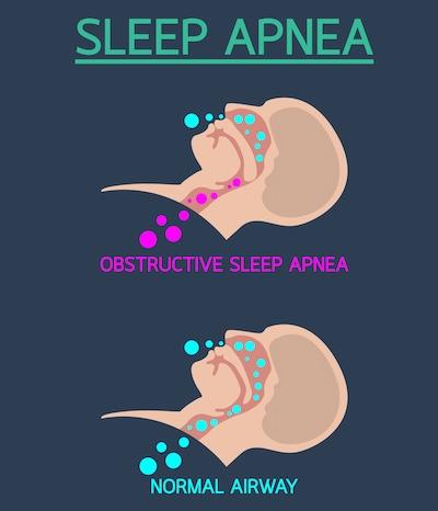 Sleep apnea obstruction poster, scottsdale az
