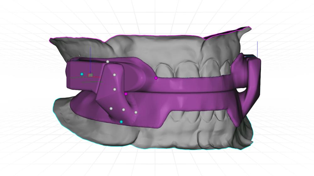 Sleep apnea mouthguard model, scottsdale az