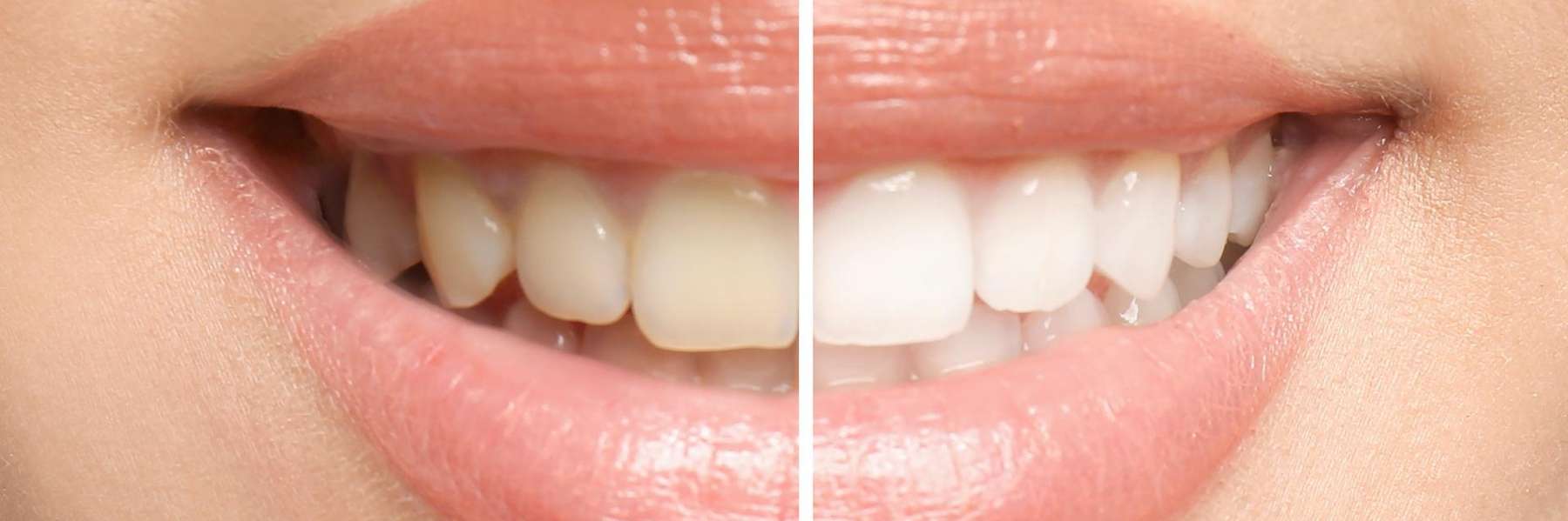 Before and after teeth whitening, scottsdale az