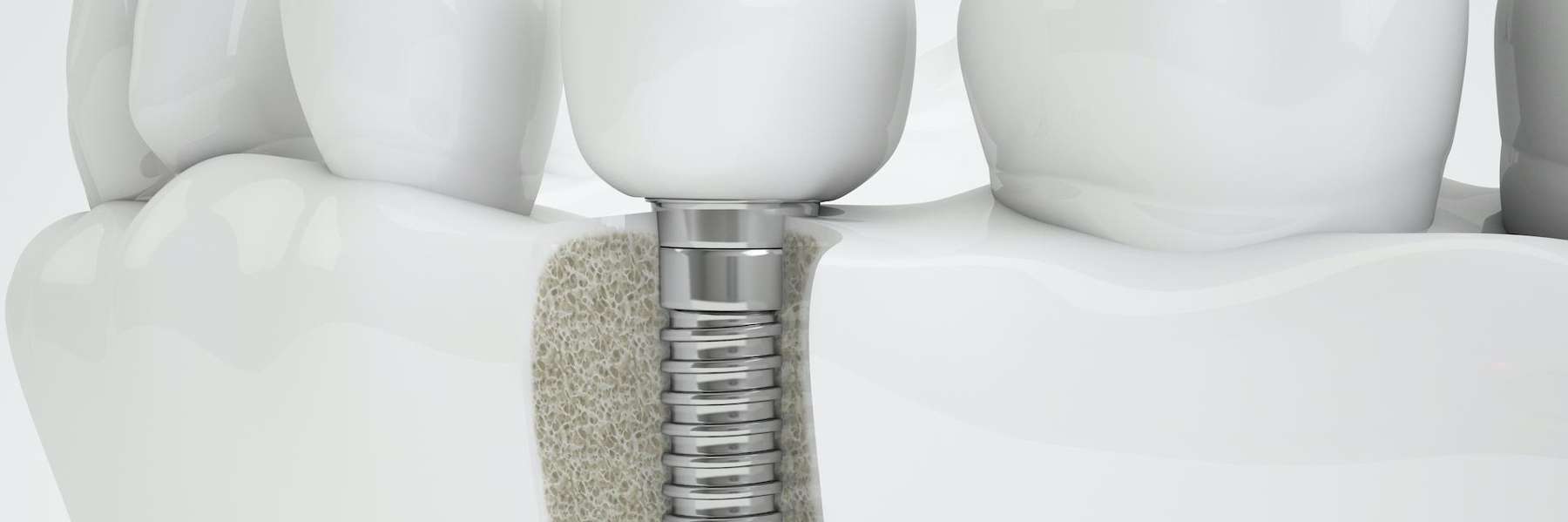 Dental implant, scottsdale az