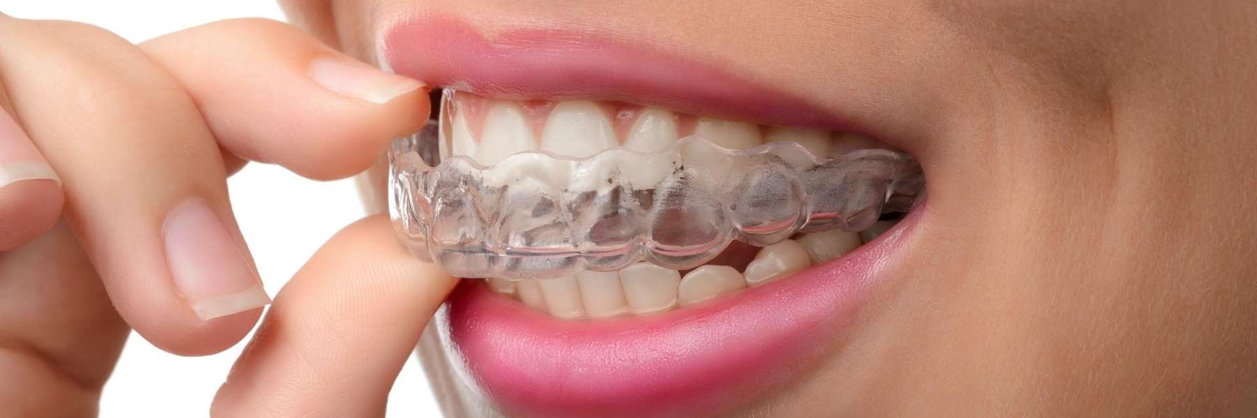 Invisalign going into teeth, scottsdale az