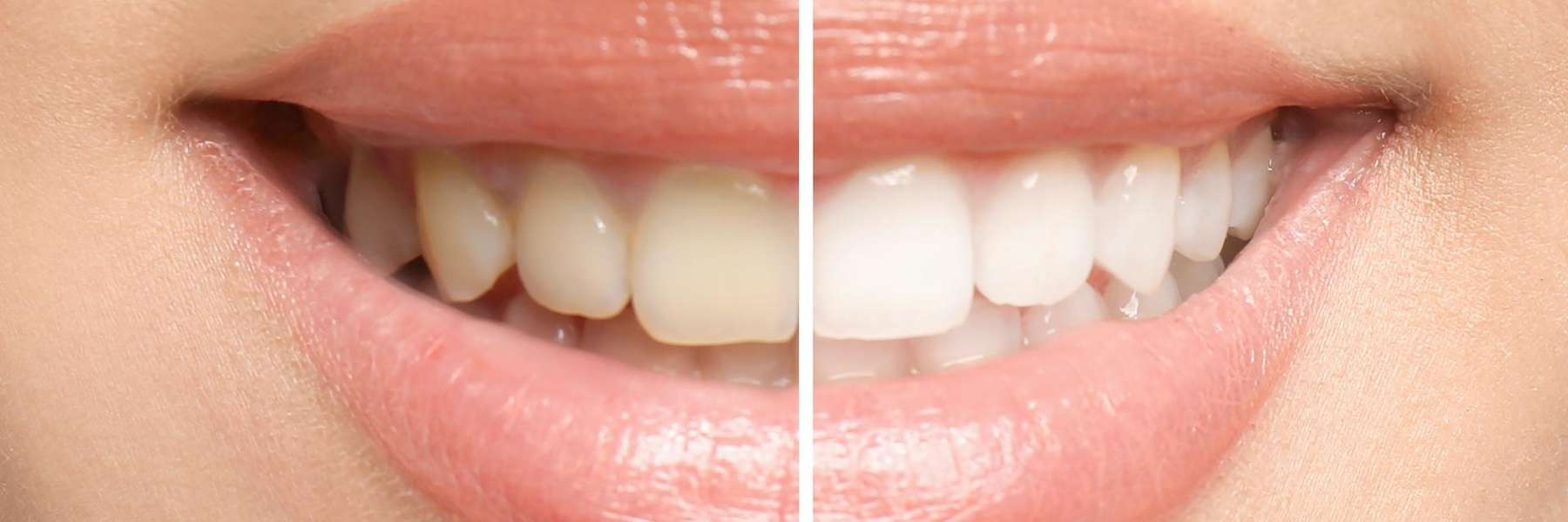Before and after teeth whitening, scottsdale az