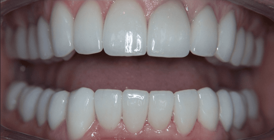 dental crowns in scottsdale- after photo