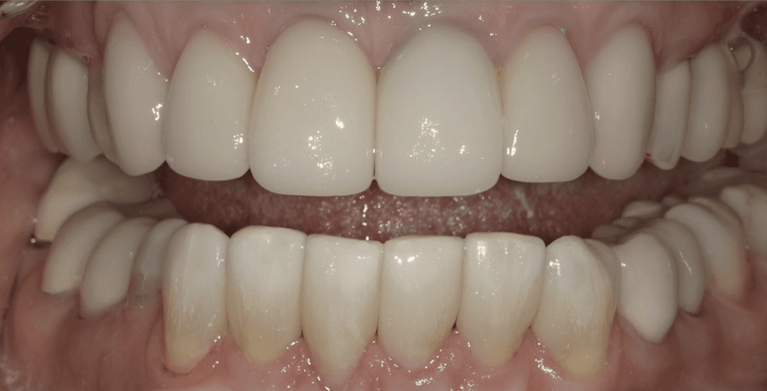 Veneers in Scottsdale- after photo