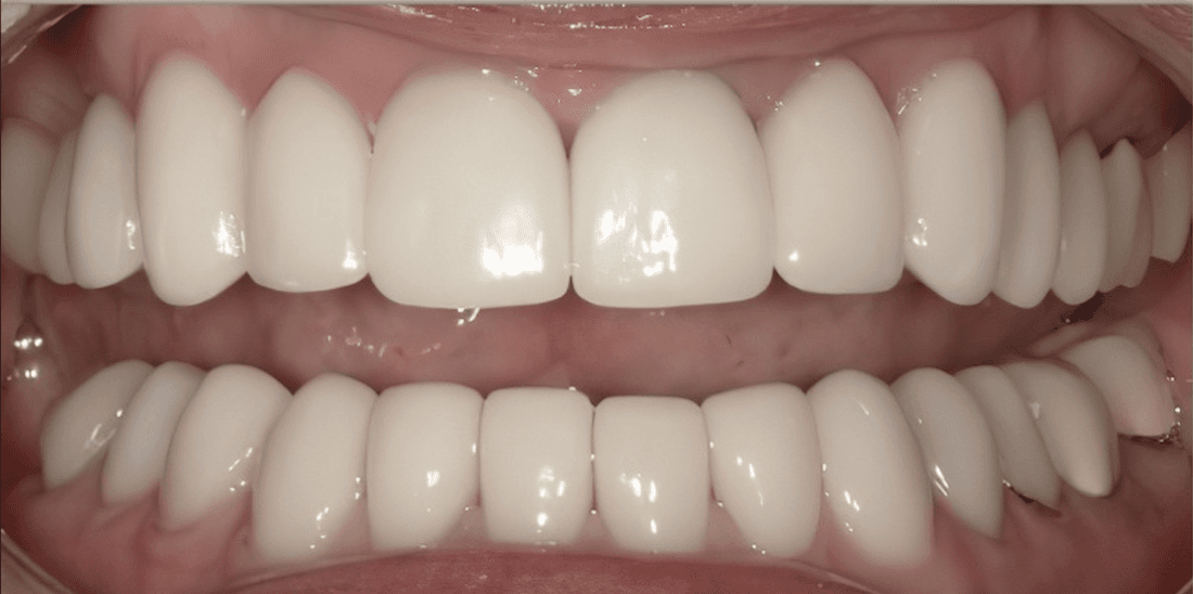 Veneers in Scottsdale- after photo