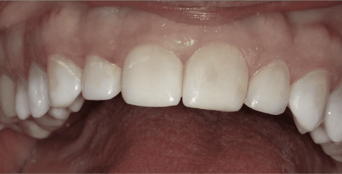 smile makeover in scottsdale- after photo