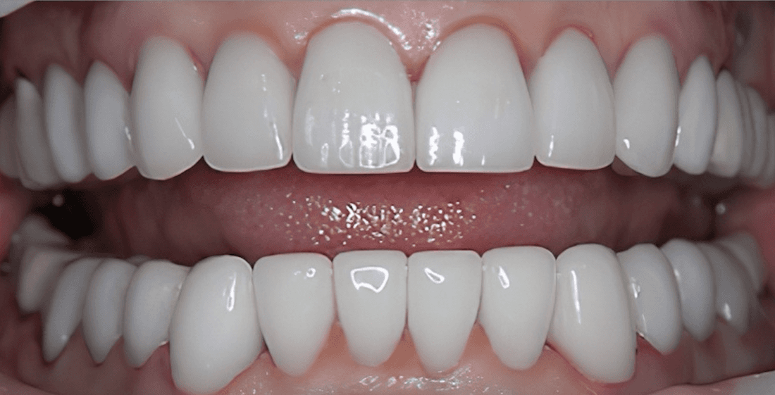 dental crowns in scottsdale- after photo