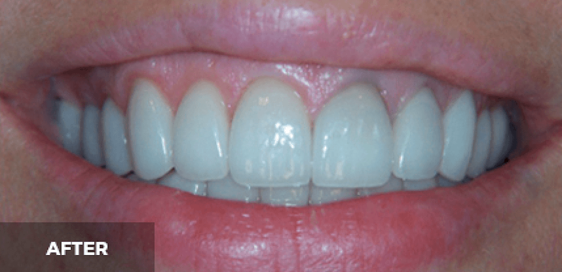 Veneers in Scottsdale- after photo