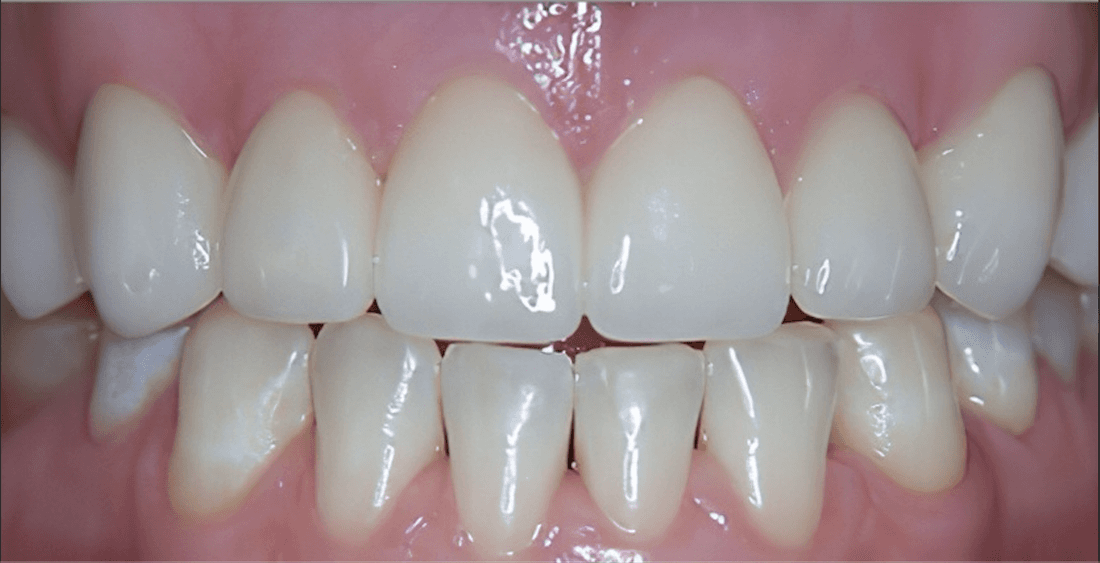 dental crowns in scottsdale- after photo