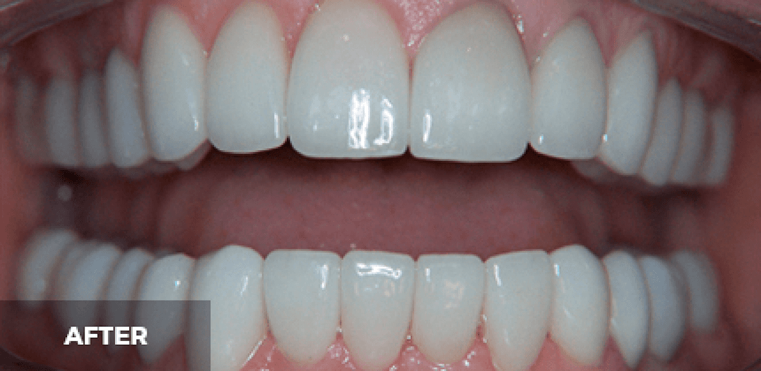 smile makeover in scottsdale- after photo
