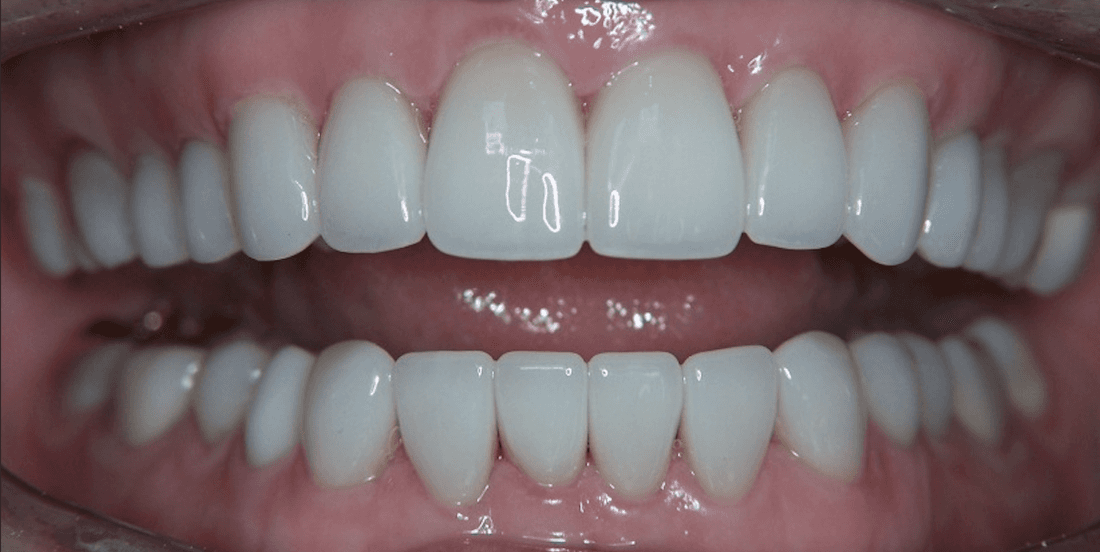 Veneers in Scottsdale- after photo