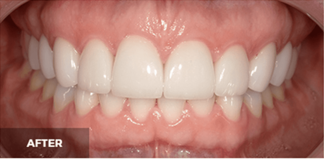Veneers in Scottsdale- after photo