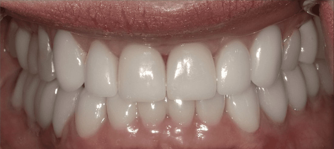 dental crowns in scottsdale- after photo