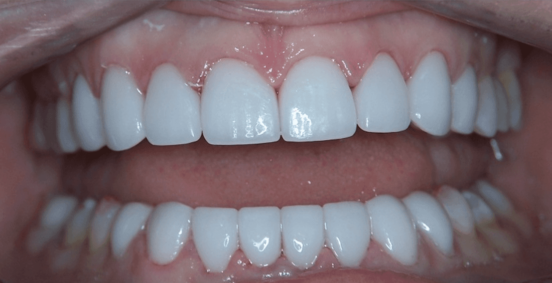 Veneers in Scottsdale- after photo