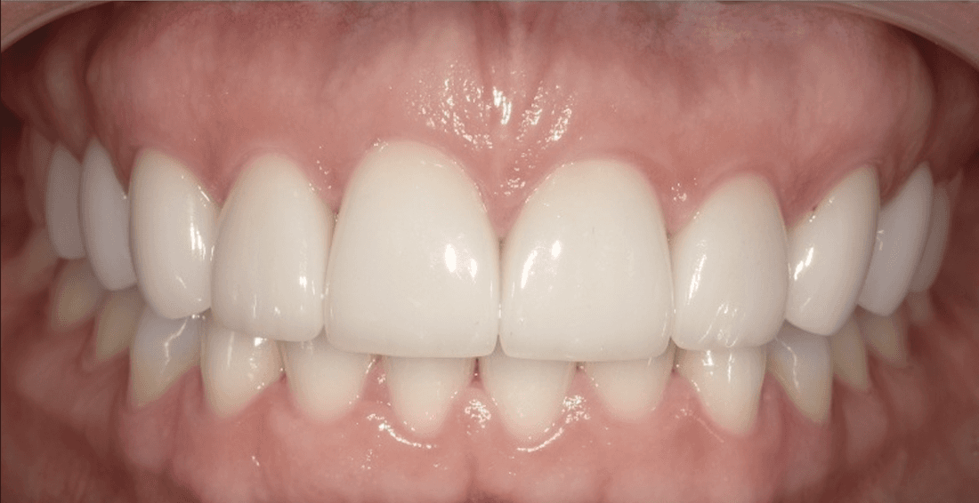 dental crowns in scottsdale- after photo