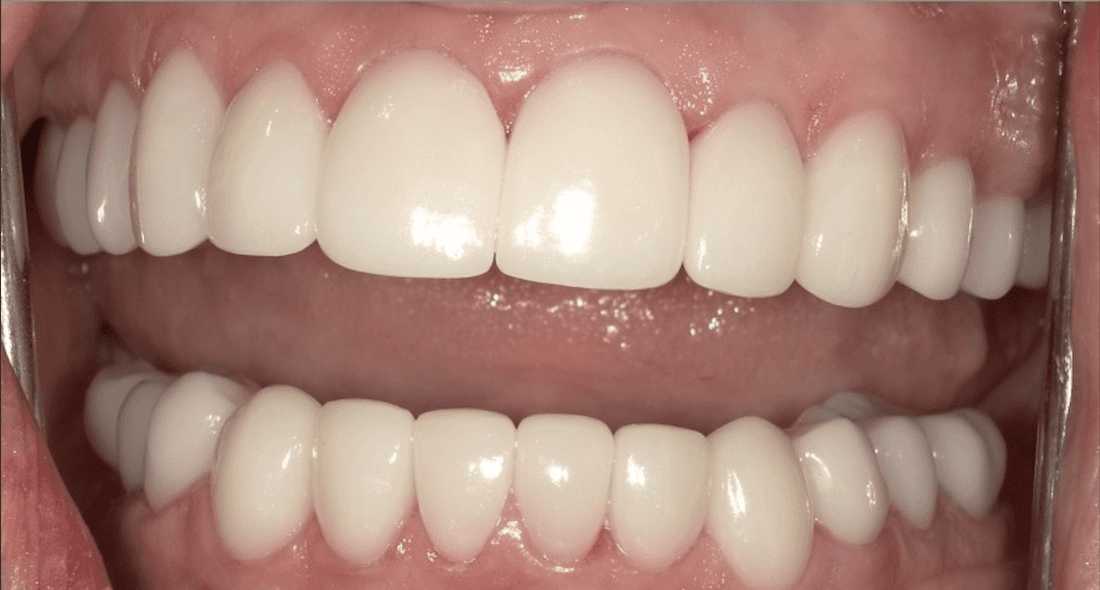 Veneers in Scottsdale- after photo