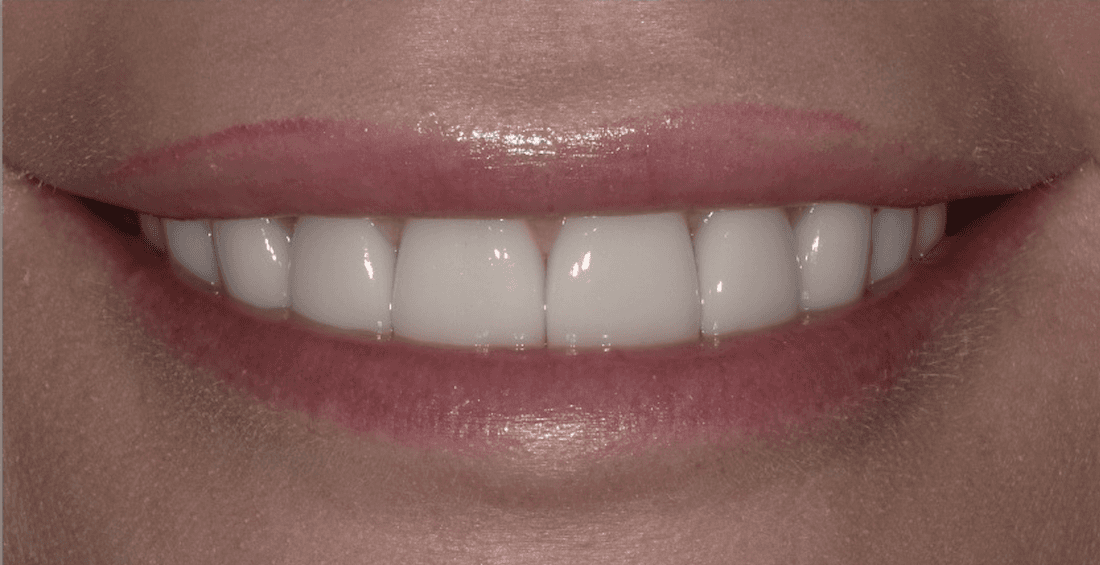 Veneers in Scottsdale- after photo