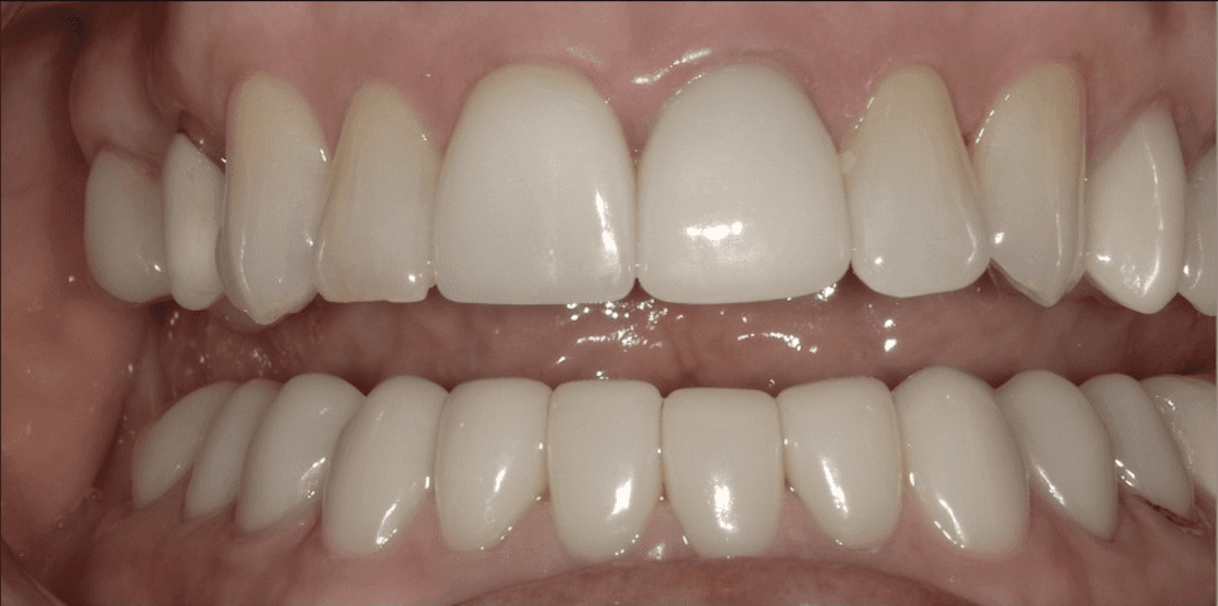 Veneers in Scottsdale- before photo