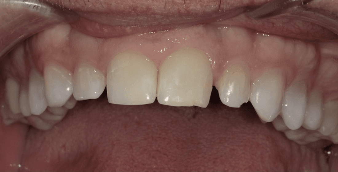 smile makeover in scottsdale- before photo