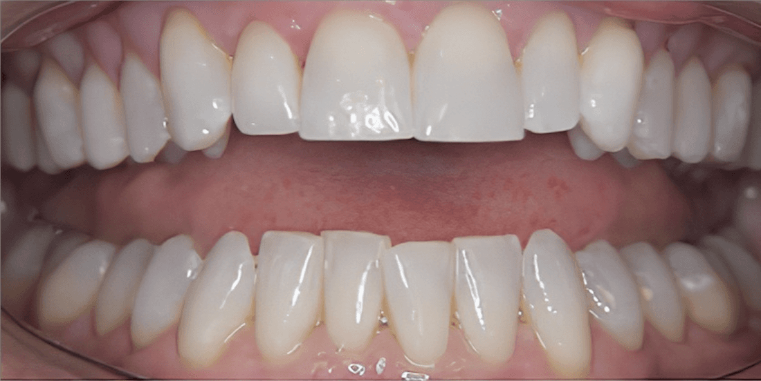 Veneers in Scottsdale- before photo