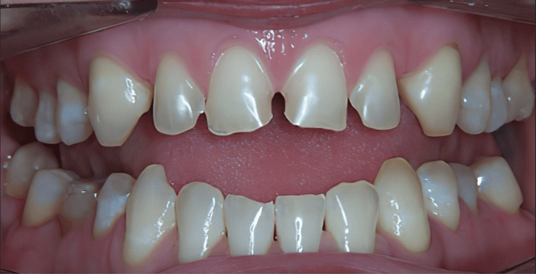 dental crowns in scottsdale- before photo