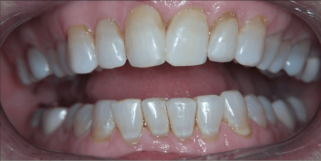 Veneers in Scottsdale- before photo