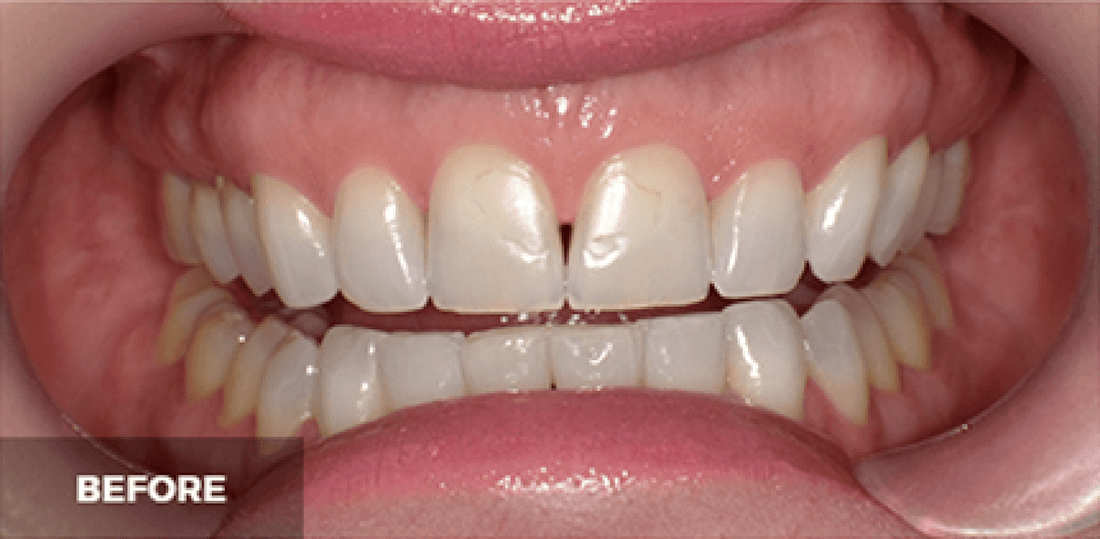 Veneers in Scottsdale- before photo