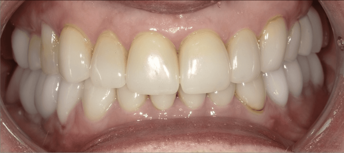 dental crowns in scottsdale- before photo