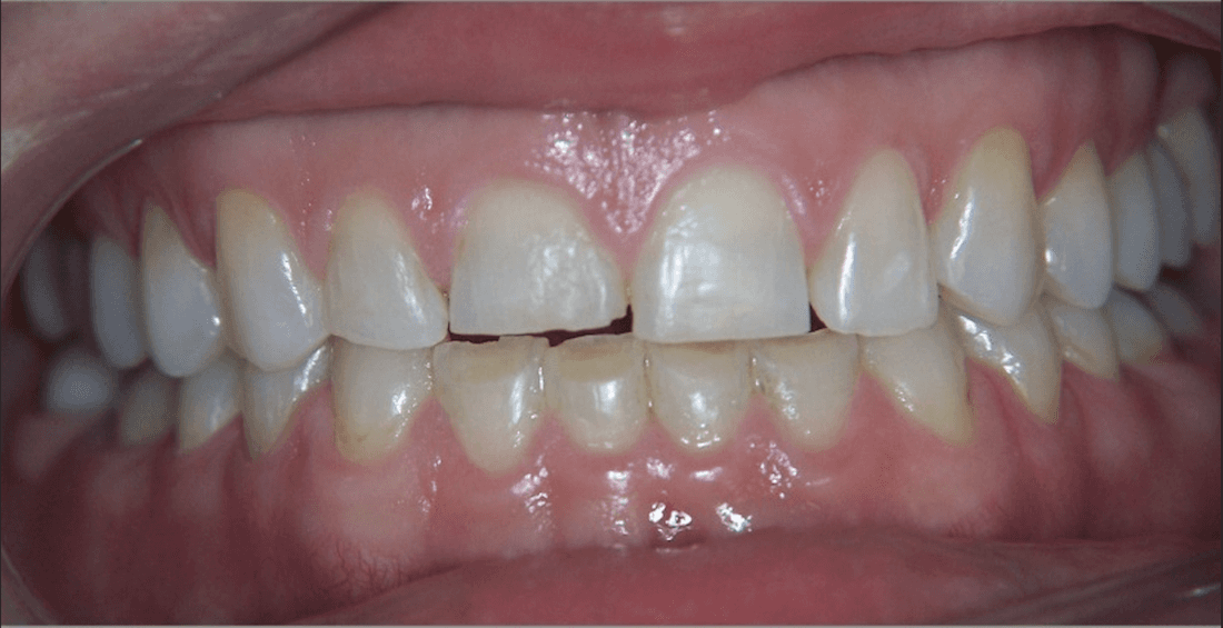 Veneers in Scottsdale- before photo