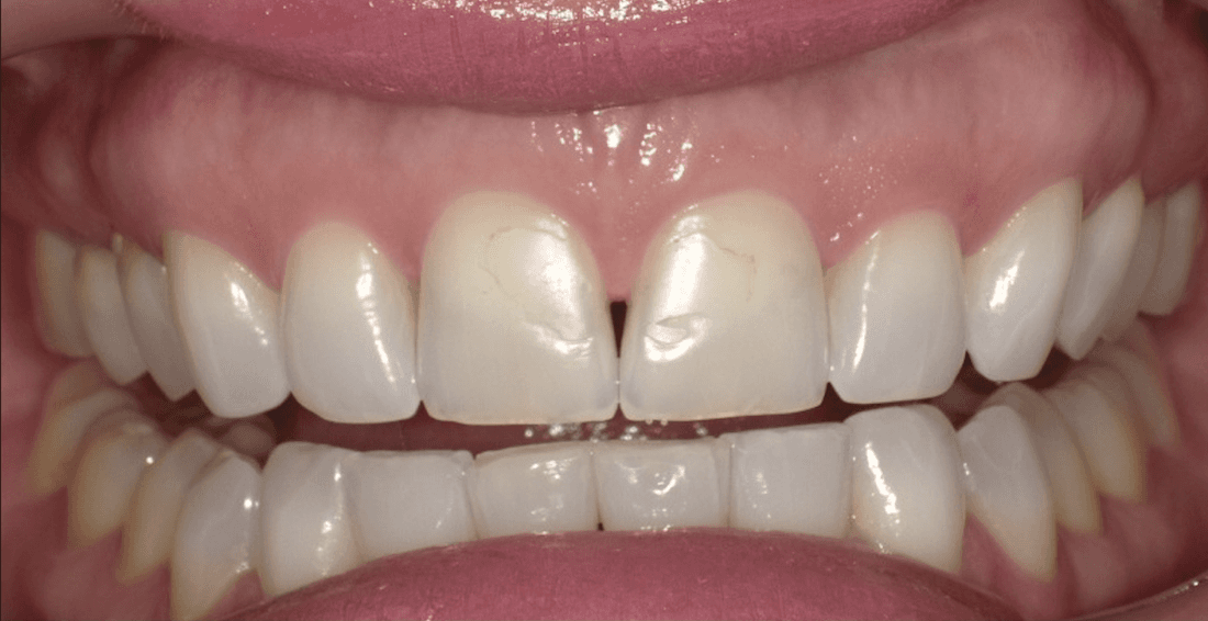 dental crowns in scottsdale- before photo