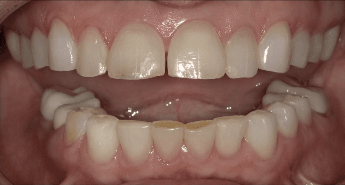Veneers in Scottsdale- before photo