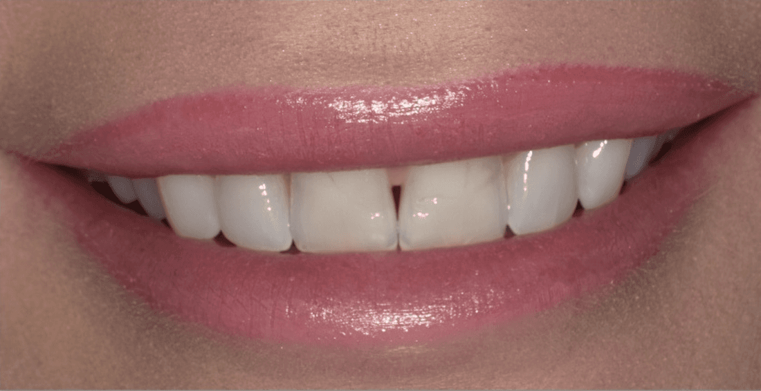 Veneers in Scottsdale- before photo