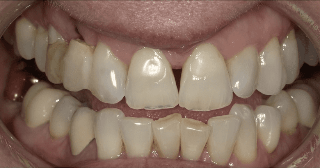 smile makeover in scottsdale- before photo