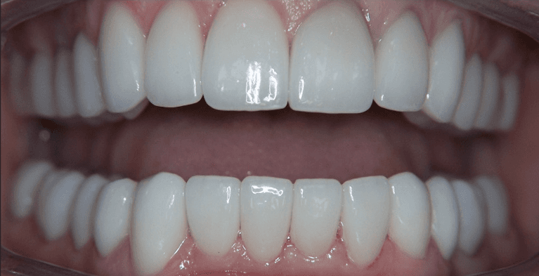 Smile-Makeover-in-Scottsdale-After-Image