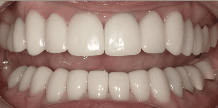 Veneers in Scottsdale- after photo