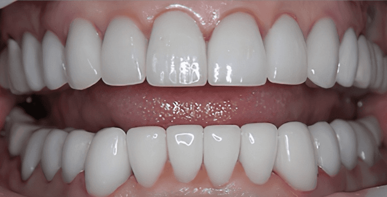 dental crowns in scottsdale- after photo