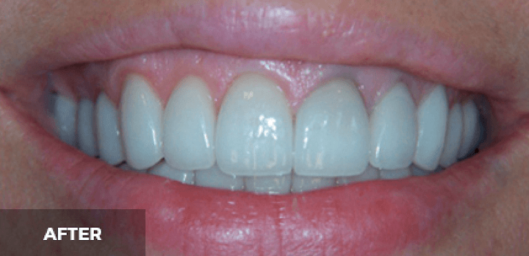 Veneers in Scottsdale- after photo