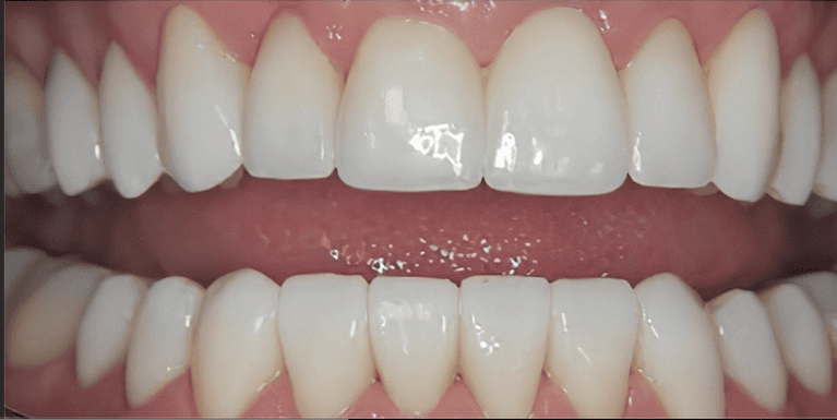 Veneers in Scottsdale- after photo