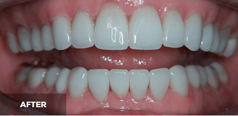 dental crowns in scottsdale- after photo