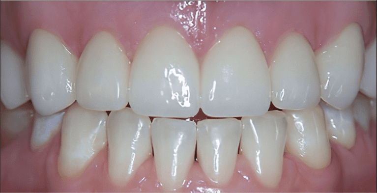 dental crowns in scottsdale- after photo