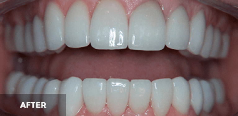 smile makeover in scottsdale- after photo