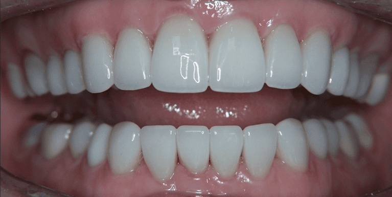 Veneers-in-Scottsdale-After-Image