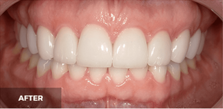 Veneers in Scottsdale- after photo