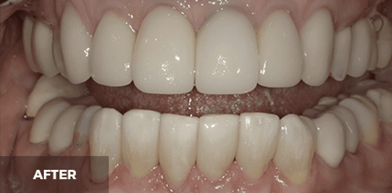 dental crowns in scottsdale- after photo