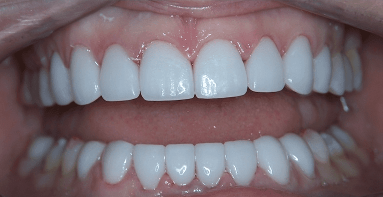Veneers in Scottsdale- after photo